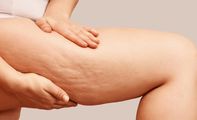  Cellulite Over 40? Here’s What Works, And What Doesn’t!